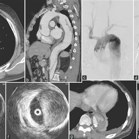 A And B Preoperative Computed Tomography Angiography In The Download Scientific Diagram