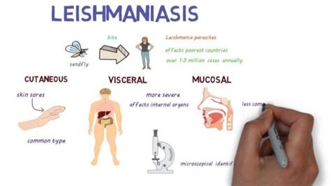 Visceral Leishmaniasis Symptoms