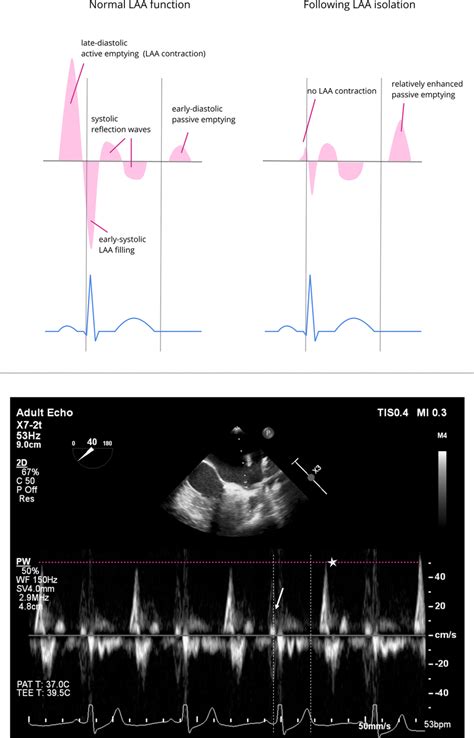 Transesophageal Echocardiography After Left Atrial Appendage Isolation