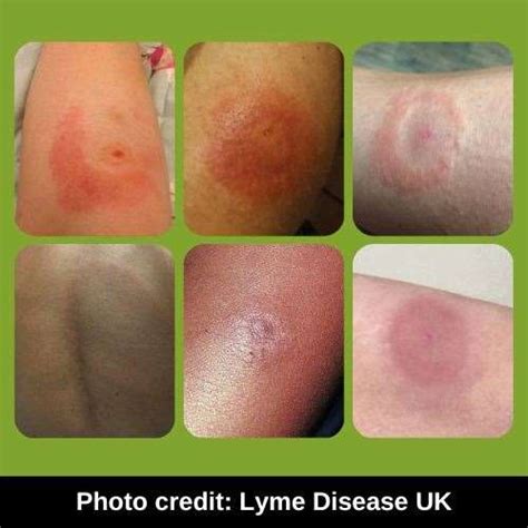 Explained Lyme Disease Why Its On The Rise And How To Stay Safe This Spring