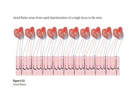 ATRIAL DYSRHYTHMIAS AND HOW TO INTERPRET IN ECG PPT