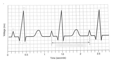 Electrocardiogram ECG Diagram Quizlet