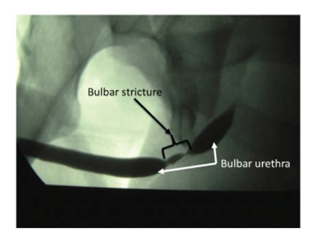 Introduction Background And Objectives Open Urethroplasty Versus