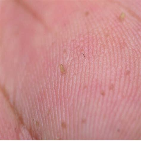 A Multiple Brownishyellowish Filiform Keratotic Papules On The Left