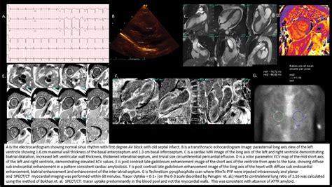 How Come It S Not Hcom Premature Ventricular Contractions Pvc And