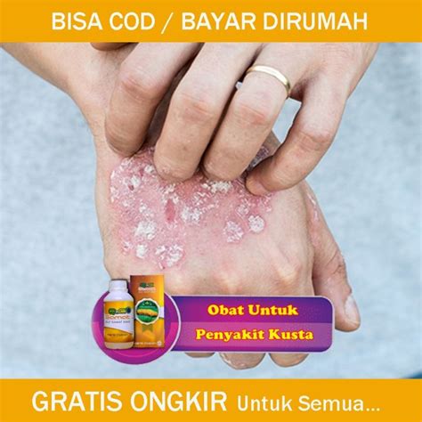 Obat Kusta Kering Dan Basah Penghilang Kusta Di Tangan Obat Herbal