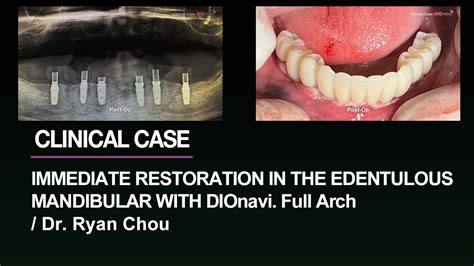 Implant Placements And Immediate Restoration In The Mandibular DIOnavi