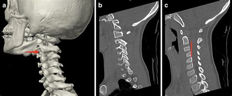 Cervical Subluxation