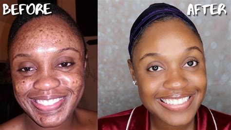 AFFORDABLE SKIN CARE ROUTINE FOR ACNE DARK MARKS AND