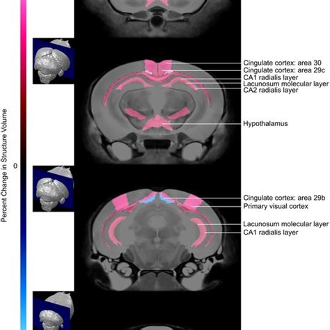 coronal magnetic resonance imaging mri slices showing  differences