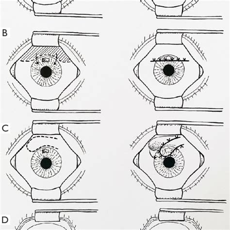 Conjunctival flap techniques. (A) Bipedicle flap; (B) partial/limbal ...