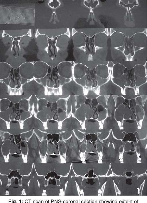 Figure From Cavernous Hemangioma Of Maxillary Sinus Semantic Scholar