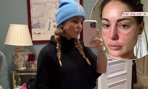 Louise Thompson Reveals She Has Lupus As She Goes For More Tests After