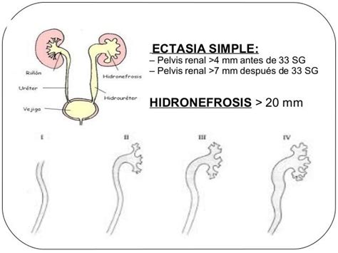 Ectasia Pielica - Ectasiapielica jc