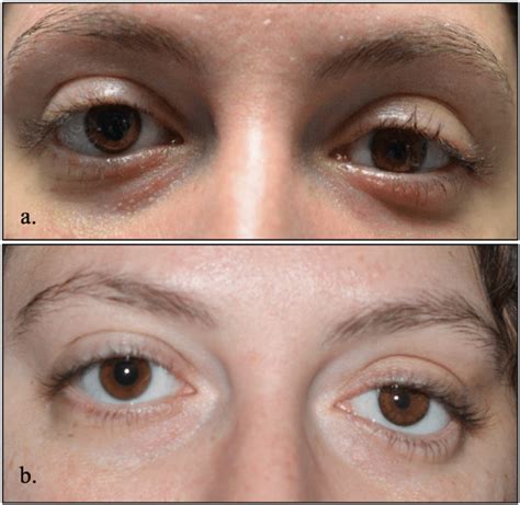 Post Operative Photographs Of The Same Patient A At 1 Month Showing