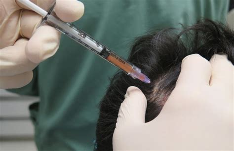 Alopecia Androgenetica Cellule Staminali E Le Nuove Terapie Di