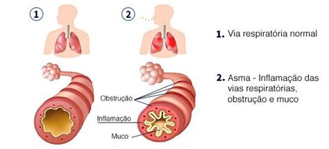 Asma brônquica sintomas e tratamentos