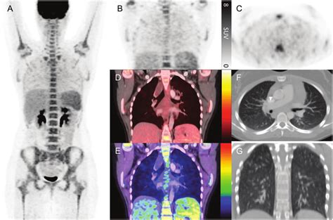 Year Old Female With Hodgkin Lymphoma Restaging Fdg Pet Ct After