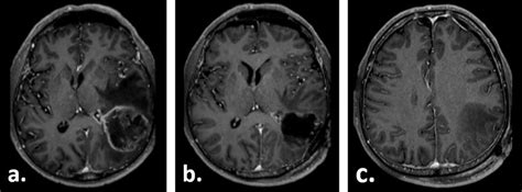 Gadolinium Enhanced T Weighted Axial Mri Of The Patient Preoperatively