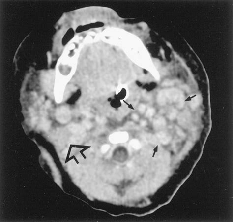 Contrast Enhanced Axial Computed Tomography Scan Reveals Multiple Round