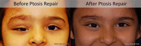 Blepharoplasty Before And After Weber Facial Plastic Surgery