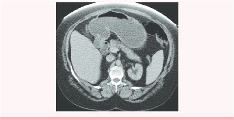 Transaxial CT image shows atrophic fatty pancreas in a patient of IDDM ...