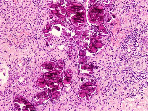 Chondrocalcinosis Histology