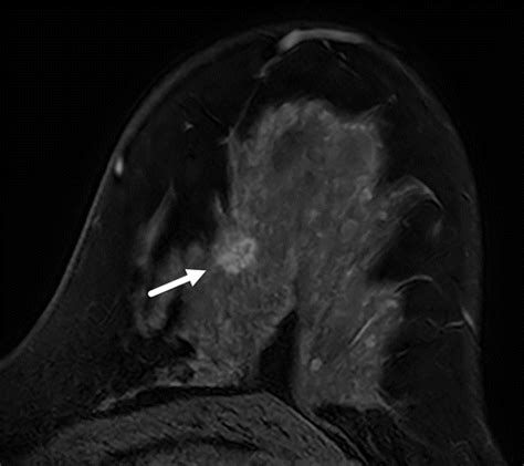 Mri Guided Breast Biopsy Case Based Review Essential Techniques And Approaches To Challenging