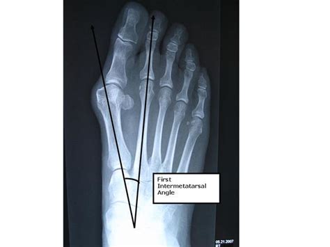 Hallux Valgus - Foot & Ankle - Orthobullets