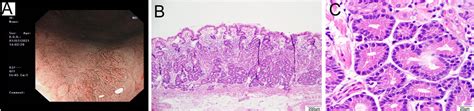 Pathology And Oncology Research Gastric Epithelial Neoplasm Of Fundic