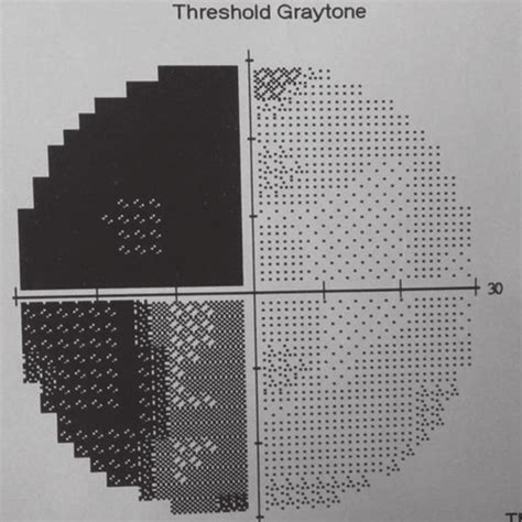 Visual field chart in the left eye showing left temporal hemianopsia ...