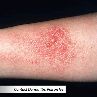 Rash Types Pictures Of Common Rashes Treatment Symptoms Covid