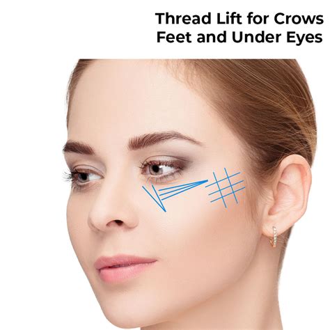 Thread Lift For Crows Feet And Under Eye Allurant Medical Spa