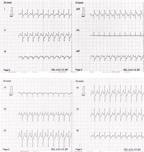 For Those Who Carry Adenosine Do You Ever Switch It Up And Try The Modified Valsalva R Ems