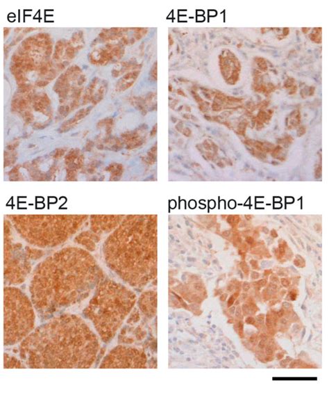 Representative Tumour Sections Showing Immunoreactivity As Labelled