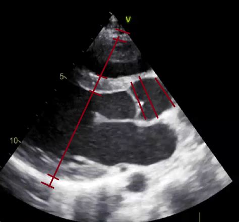 plax measurements diastole diagram quizlet