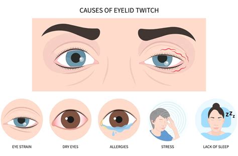 Why Do My Eyes Twitch Causes Of Eye Twitching And How To Manage It