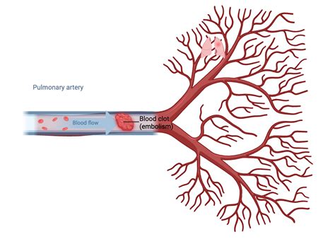 Pulmonary Embolism Biorender Science Templates