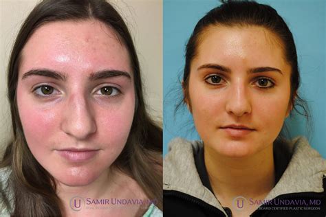 Closed Rhinoplasty Rhinoplasty Nose Job Crooked Nose