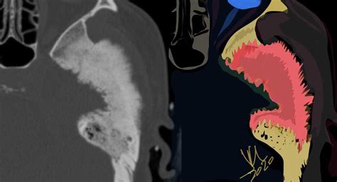 Tegmen Tympani Meningioma-CT - NeuroRad911 Tegmen tympani meningioma