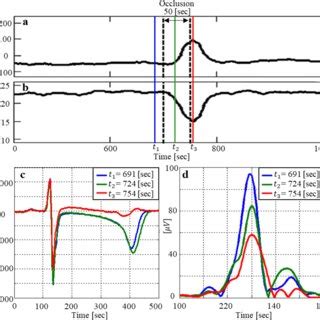 Intracardiac High Frequency QRS Signals Recorded At Three Stages I