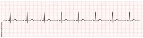 EKG showing normal sinus rhythm of patient Stock Vector | Adobe Stock