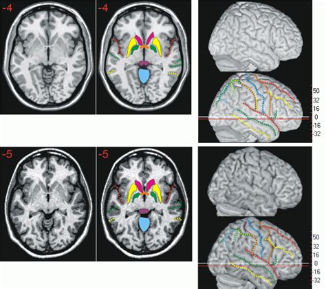 Neuroanatomy Atlas The Anterior Commissure