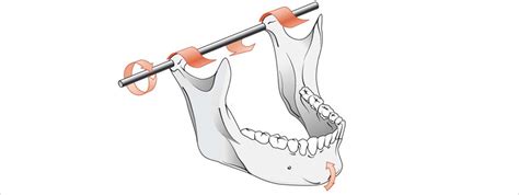 Temporomandibular Joint Dysfunction Treatment Dental Trends