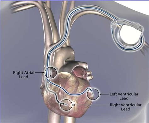 Cardiac Resynchronization Therapy