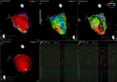 Catheter Ablation In Arrhythmic Cardiac Diseases Endocardial And