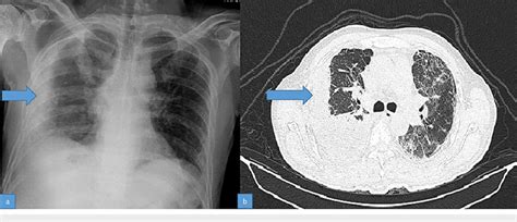 A Chest Radiograph Showing Empyema On The Right B Hrct Of The