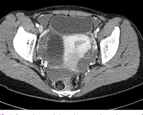 Figure From Massive Hemoperitoneum Due To A Ruptured Corpus Luteum