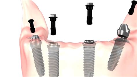 All On 4 Dental Implants Procedure Youtube