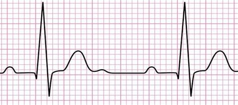 Waveforms Intervals And Segments Diagram Quizlet